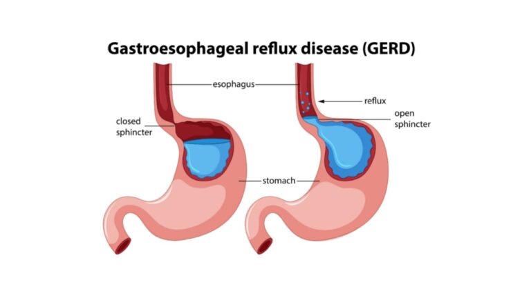 GERD (Gastroesophageal reflux disease) Medical vector created by brgfx - www.freepik.com